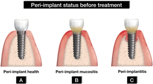 Peri-implant mucositis and peri-implantitis are the peri implant diseases involving the soft tissues and bone structure around the implant