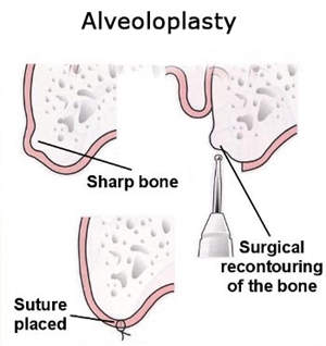 What is jawbone reshaping or dental alveoloplasty?