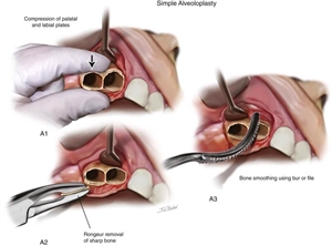 Alveoloplasty - a surgical dental procedure of creating a solid and smooth alveolar ridge