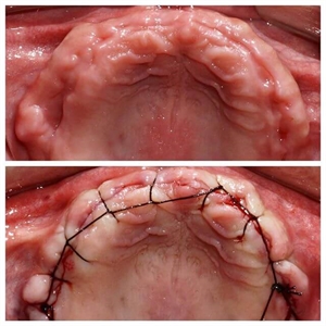 Alveoplasty procedure - before and after photos