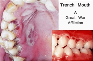 Trench mouth - acute necrotizing ulcerative gingivitis (ANUG)