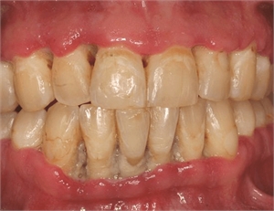 Trench mouth is an acute inflammation of the gums caused by bacteria. It has a sudden onset and is characterized by swollen, painful and bleeding gums and ulcers on the attached gingiva.