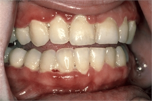Vincent stomatitis, also known as Trench mouth or ANUG, is a treatable dental disease. Treatment involves dental cleaning, scale and polish procedures, scaling and root planning and courses of antibiotics.