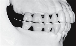 Curve of Spee in lower and top teeth