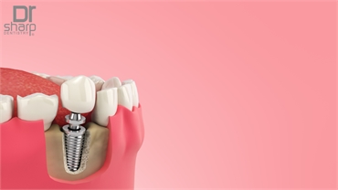 Does The Expiration Date Apply To Dental Implants
