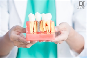 Dental Implants in Miami