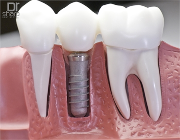 Is it Worth it to Have Dental Implants