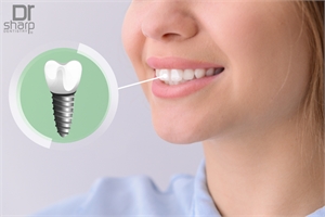 Dental Implants Miami