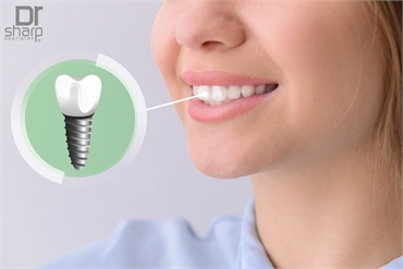 7 Facts About Dental Implants That You Probably Didn't Know