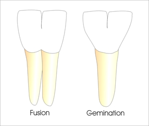 Tooth gemination in dentistry