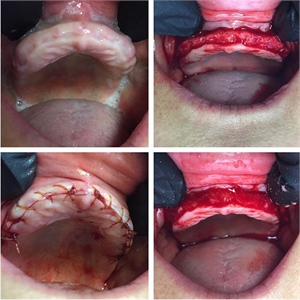 Patient couldn’t wear a denture because of pain in the gums due to undercuts and sharp edges from the remaining alveolar ridge. Alveoplasty procedure is performed – a flap is raised and the ridge of the bone is rounded, smoothed over and reshaped.