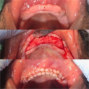 Preprosthetic alveoplasty is performed to achieve a comfortable fit for a mandibular denture. Undercuts are removed and the ridge is recontoured to achieve a perfect fit for the denture.