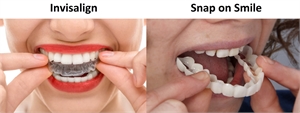 What is the difference between Snap-On Smile and Invisalign?