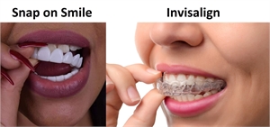 Difference between Invisalign and Snap on Smile