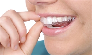 Invisalign is an invisible clear aligner used for teeth straightening