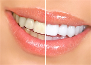 Teeth whitening effect before and after