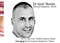Dental Implant placements Perth