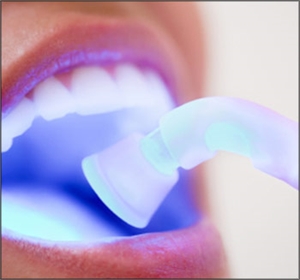 Cost And Benefits - Laser Dentistry