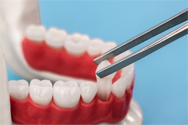 Are You a Candidate for Dental Implants Understanding the Basics