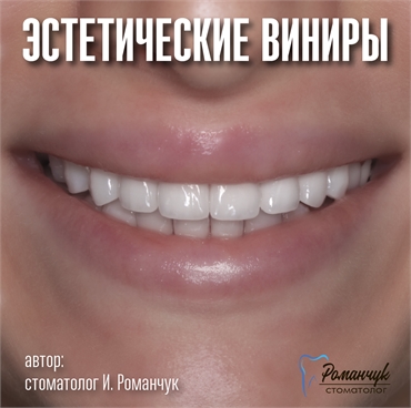 dental-veneers-11