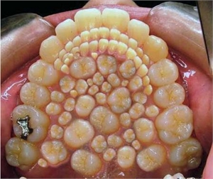 Hyperdontia is a condition of having extra teeth in the mouth - supernumerary teeth.
