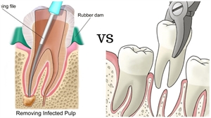Root canal treatment or extraction - this is the question.