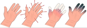 Stages of Hand-Arm Vibration Syndrome medical condition