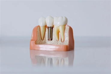 3 Effective Treatments for Replacing a Missing Tooth 