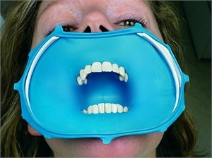 Dental dam on a patient. All the front teeth and the premolars are isolated with a rubber dam.