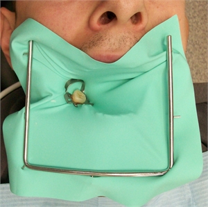 Single tooth isolation with a rubber dam.