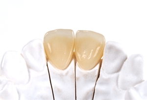 Zirconia Crown: A Combination of Beauty and Strength