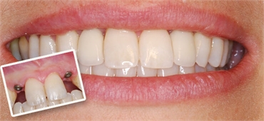 Restorative Dentistry Helps You Regain Life 