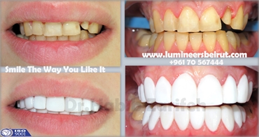 Veneers with Dr Habib Zarifeh are not the traditional veneers we don not drill your teeth  no pain a