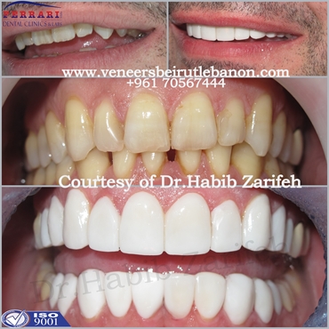 Whatever is the situation of your teeth Dr Habib Zarifeh is the best choice to repair your Smile