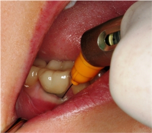 Intraligamentary dental anaesthetic injection