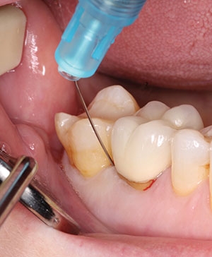Intraligamentary tooth injection for numbing 