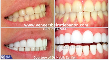  The number one Hollywood Smile dentist in Beirut Lebanon Dr Habib Zarifeh