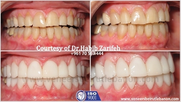 Hollywood smile in Lebanon by Dr Habib Zarifeh 