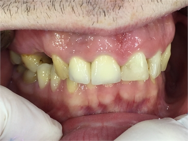 Zirconium dental bridge - BEFORE