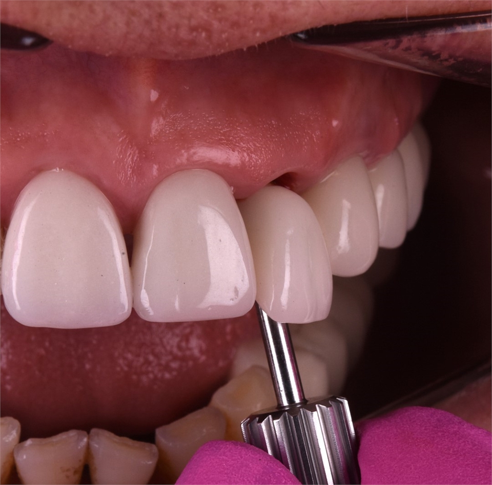 Full dental implant with metal ceramic crown 799 euros