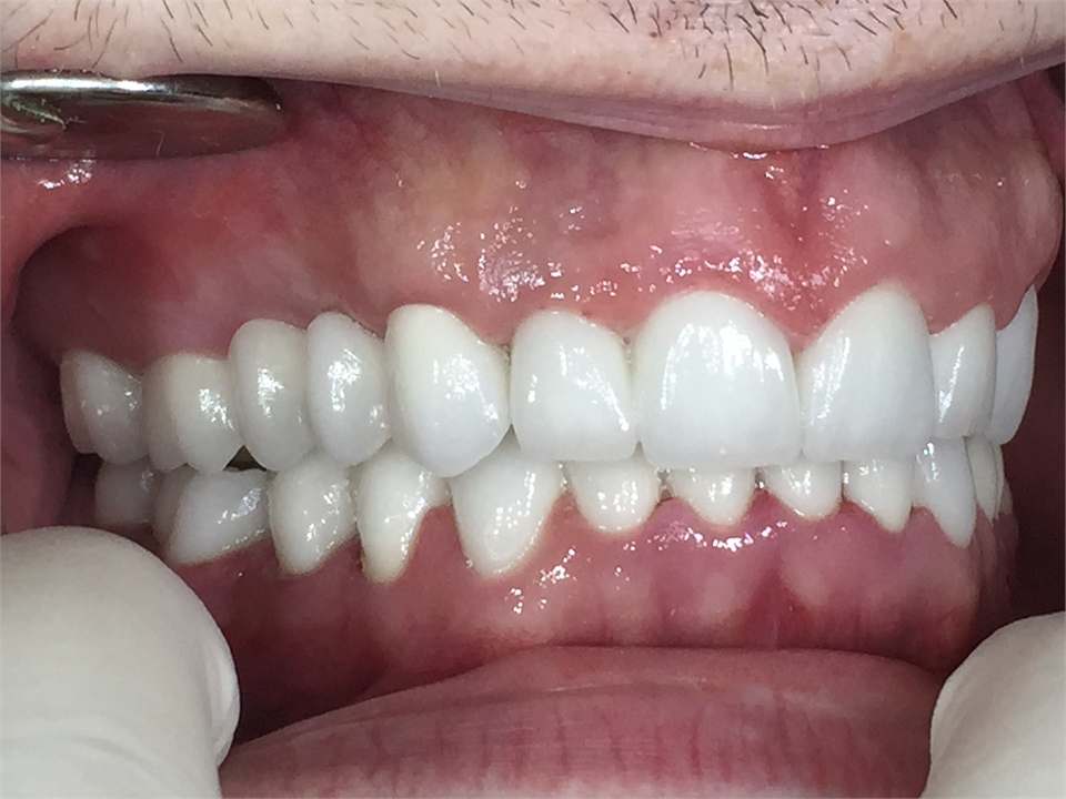 Zirconium dental bridge - AFTER