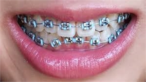 How To Be Confident When You Smile With Orthodontic Specialists