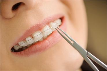 Maintaining Oral Hygiene with Invisalign