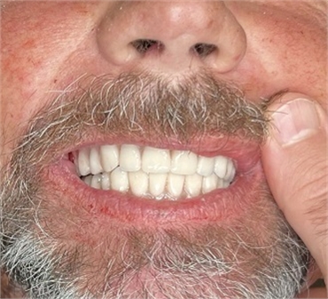 Tampa Dental Implants3