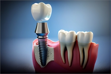Are dental implants painful.