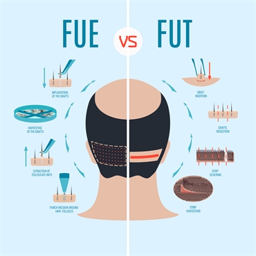 Hair Plugs Vs Hair Transplant Who Should Get What