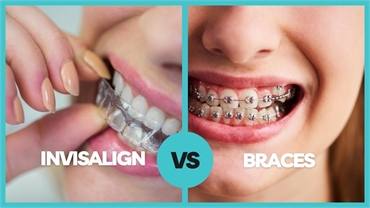 Invisalign vs Braces Which Is Better