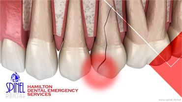 Dental Emergency in Hamilton