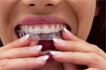 Why Invisalign is the Perfect Choice for Teeth Alignment