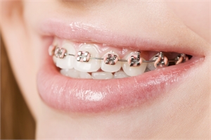 The use of the orthodontic archwire is quite common in orthodontics. 